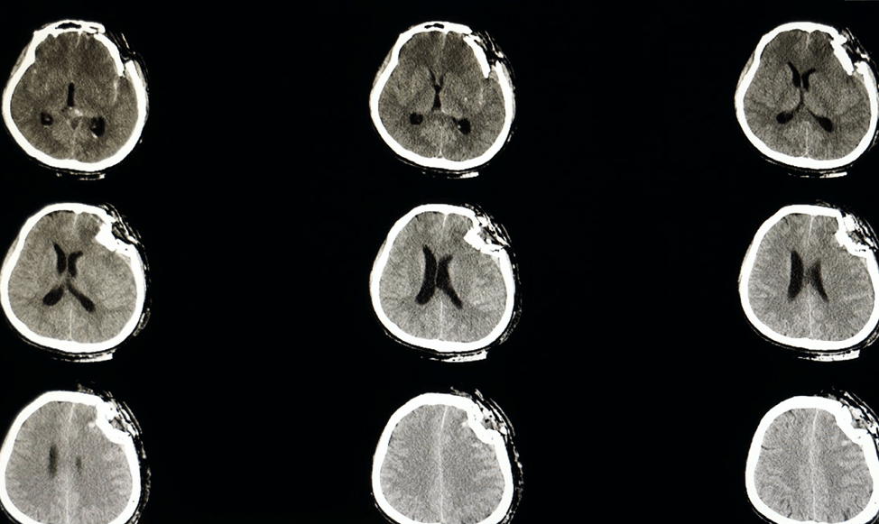 A ct scan of a person 's brain showing different sections of the brain.